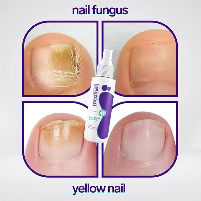 Nail Fungus Spry