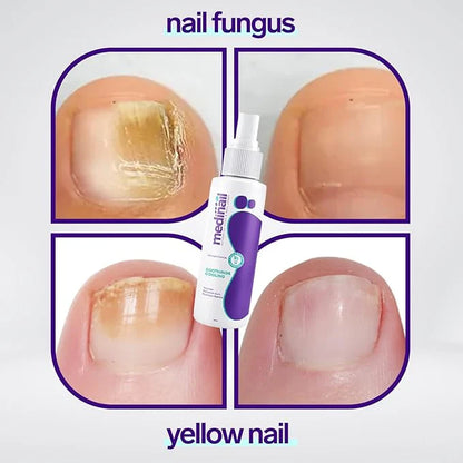 Nail Fungus Spry